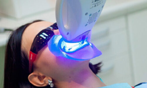 Teeth Whitening